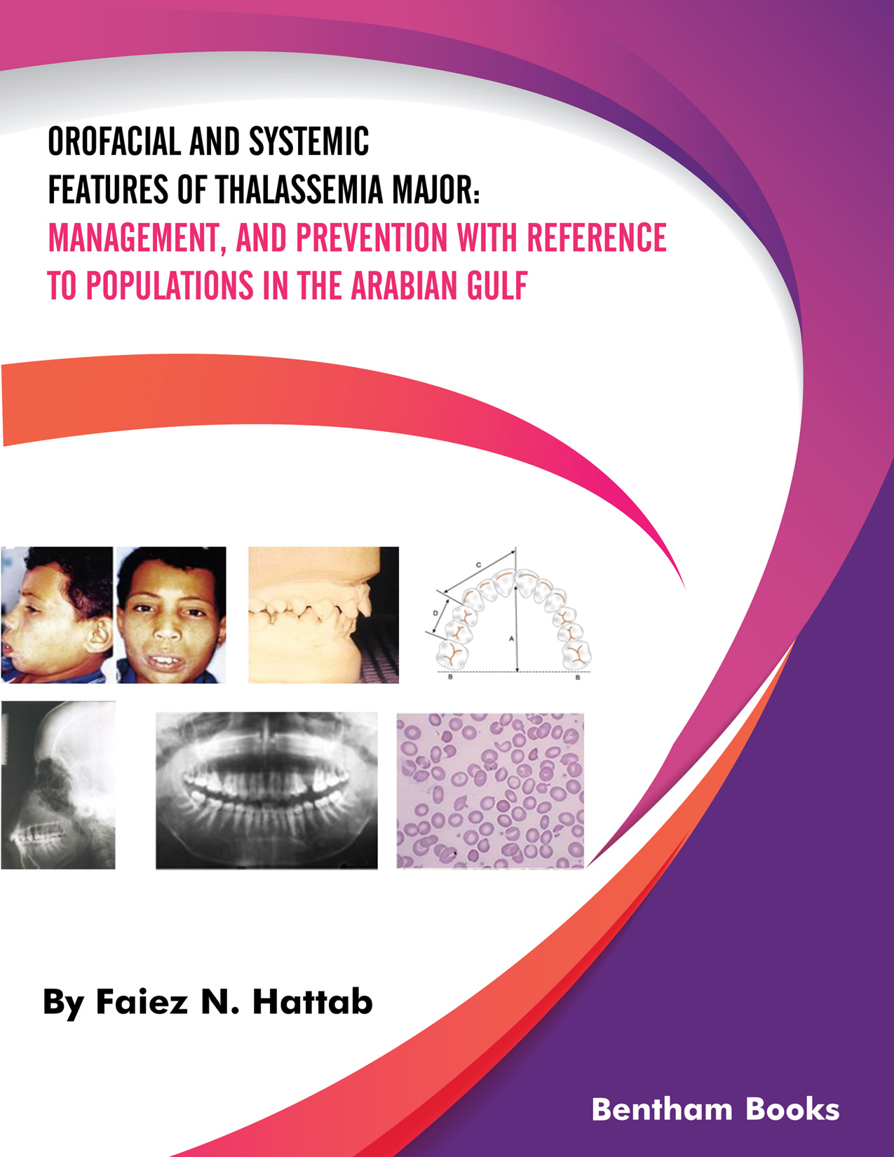 Orofacial and Systemic Features of Thalassemia Major: Management, and Prevention with Reference to Populations in the Arabian Gulf Orofacial and Systemic Features of Thalassemia Major: Management, and Prevention with Reference to Populations in the Arabian Gulf