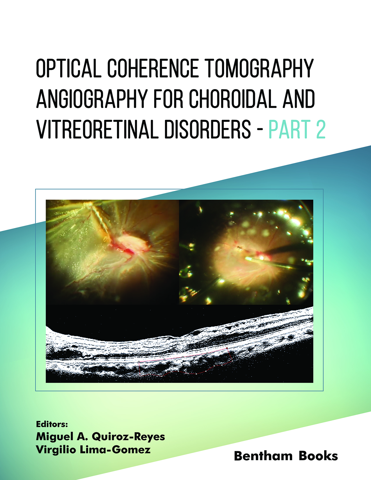 image of Optical Coherence Tomography Angiography for Choroidal and Vitreoretinal Disorders – Part 2